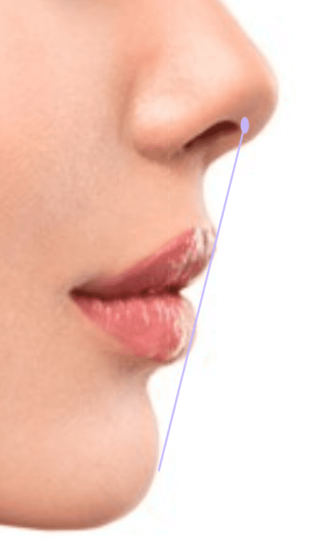 Linha de projeção labial — técnica de preenchimento Ortomagic